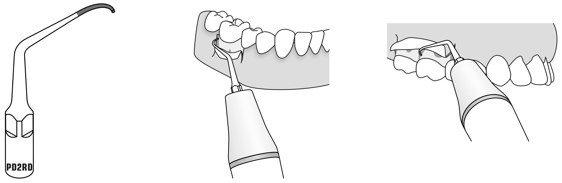 Сфера применения наконечника для скалера